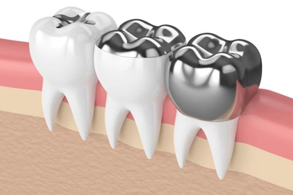 How Long Should A Dental Crown Be Expected to Last?