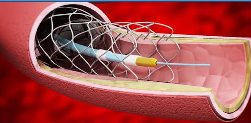 Coronary Guidewires: The Essential Tool in Cardiac Catheterization Procedures